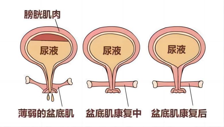 羽豐醫(yī)療丨如何有效運用振動提高盆底肌肉激活水平？